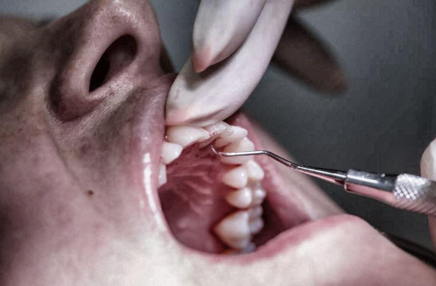 Comment choisir la bonne sculpture composite dentaire? 17