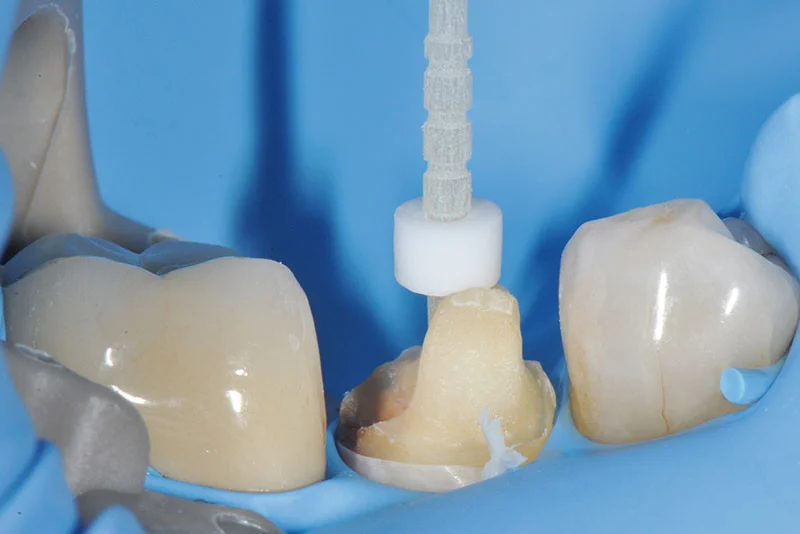 Tout sur les Tenons en Fibre de Verre et leur Collage Réussi 17